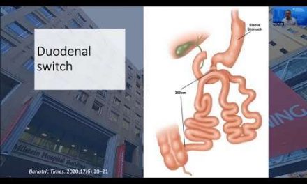Weight Loss Surgery Q&A: Duodenal Switch