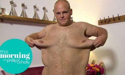 Dibsy Needs Excess Skin Removed After Incredible 19 Stone Weight Loss | This Morning
