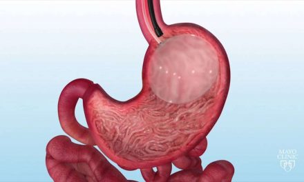 Intragastric Balloon For Weight Loss – Mayo Clinic