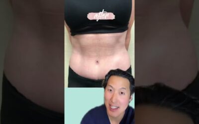 Tummy Tuck After Massive Weight Loss After Bariatric Surgery! #shorts #tummytuck