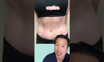 Tummy Tuck After Massive Weight Loss After Bariatric Surgery! #shorts #tummytuck