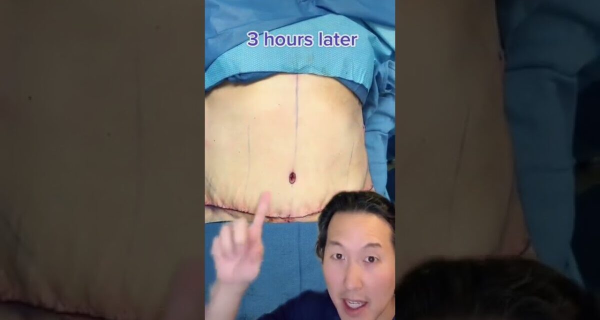 How I Remove Skin After Massive Weight Loss! #shorts #abdominoplasty