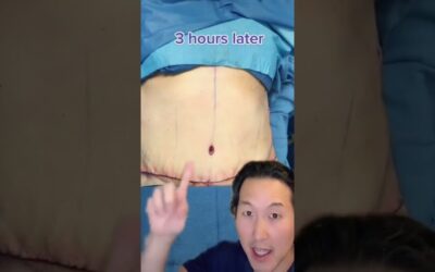 How I Remove Skin After Massive Weight Loss! #shorts #abdominoplasty
