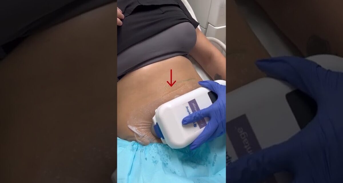 How To Freeze Your Fat With CoolSculpting? | Dr. Swati Kannan #shorts