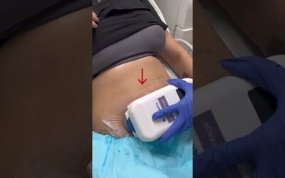 How To Freeze Your Fat With CoolSculpting? | Dr. Swati Kannan #shorts
