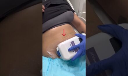 How To Freeze Your Fat With CoolSculpting? | Dr. Swati Kannan #shorts