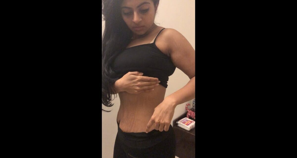 LOOSE SKIN & STRETCH MARKS – My 100 POUND WEIGHT LOSS
