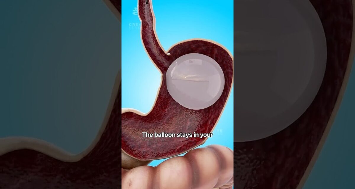 How A Gastric Balloon Helps With Weight Loss 😮 # Shorts #viralvideo – Creativelearning3d