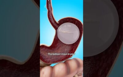How A Gastric Balloon Helps With Weight Loss 😮 # Shorts #viralvideo – Creativelearning3d