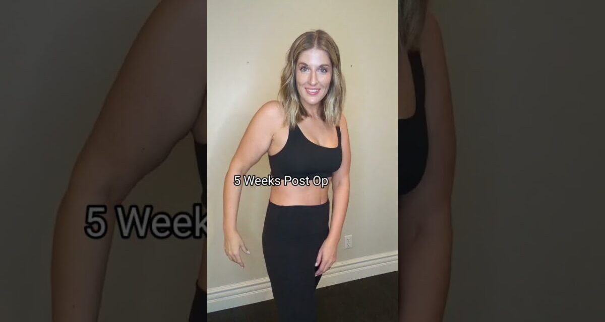 Skin Removal After 100+ Pound Weight Loss