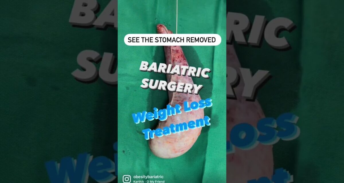 Weight Loss Operation In Surat – Bariatric Surgery In India