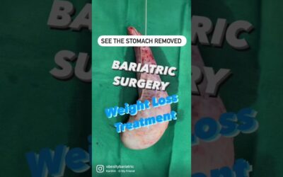 Weight Loss Operation In Surat – Bariatric Surgery In India