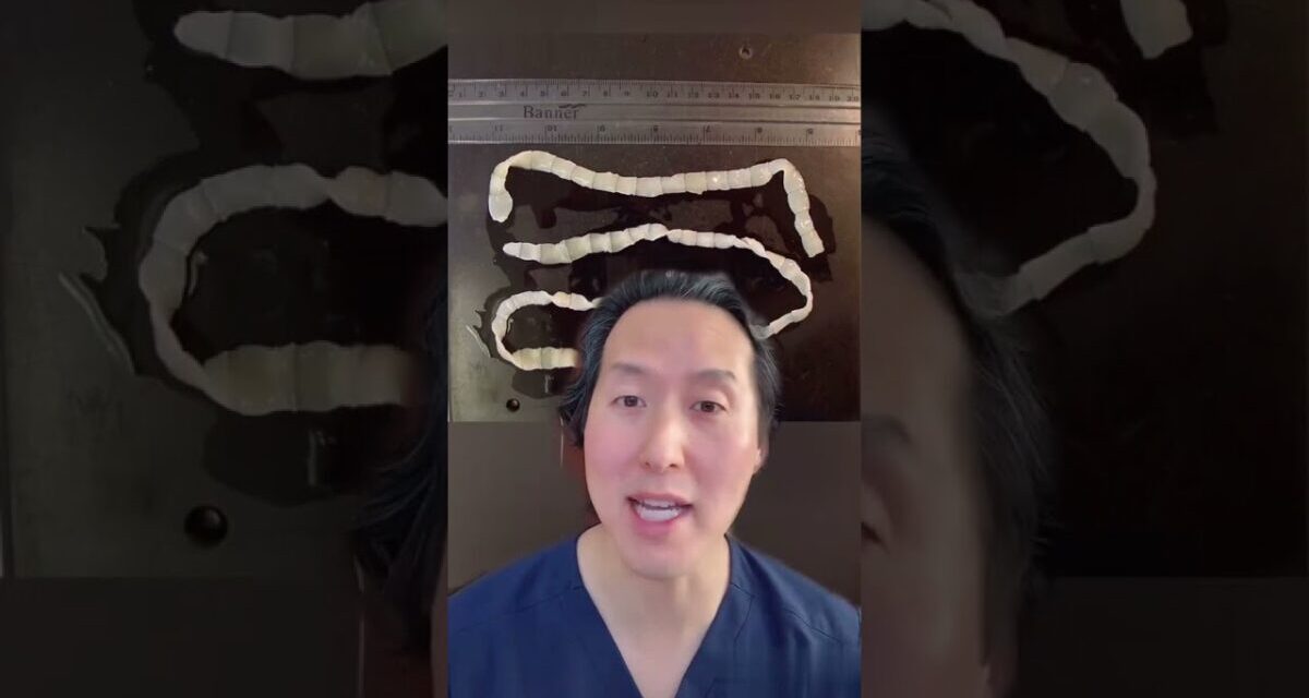 Weight Loss Due To Tapeworms?!?! It’s True #shorts
