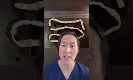 Weight Loss Due To Tapeworms?!?! It’s True #shorts